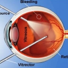 Vitreo Retina Services