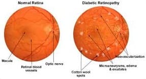 Diabetic retinopathy
