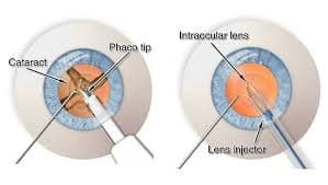 Phacoemulsification