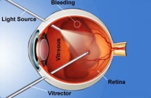 Laser treatment of the retina