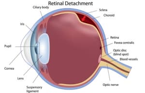 Retinal detachment