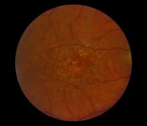 Retinal scan showing dry AMD